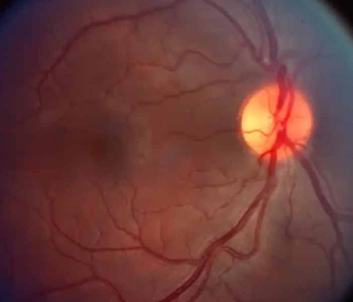 scotoma evolution optic neuritis